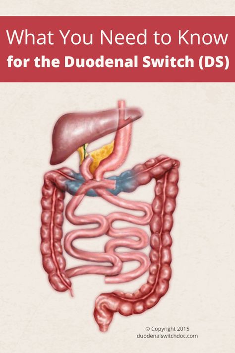 What You Need to Know for the Duodenal Switch (DS) : ObesityHelp Duodenal Switch Before And After, Duodenal Switch Diet, Duodenal Switch Recipes, Duodenal Switch Surgery, Duodenal Switch, Gastric Bypass Sleeve Post Op Liquid Diet, Gastric Bypass Revision Surgery, Gastric Bypass Sleeve Reset, Modified Duodenal Switch