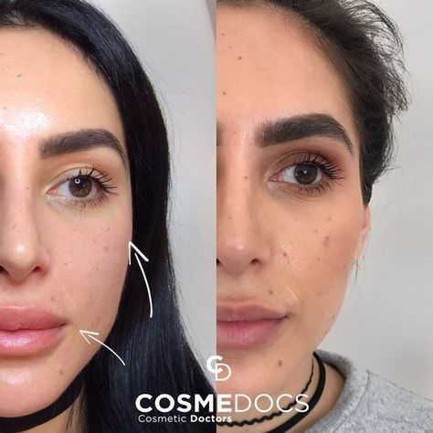 Cheekbone Filler, Facial Profile, Cheek Lift, Face Fillers, Facial Bones, Hyaluronic Acid Fillers, Cheek Fillers, Injectables Fillers, High Cheekbones