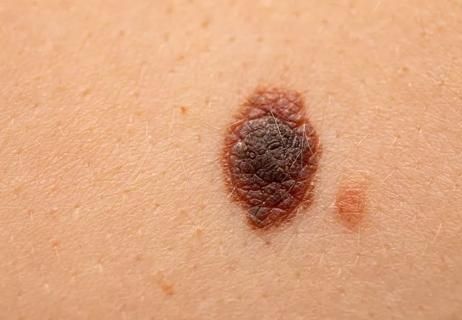 How To Tell if a Mole Is Cancerous: 8 Signs Cancerous Moles, Skin Moles, Cleveland Clinic, Best Detox, 8th Sign, Healthy Routine, Detox Drinks, Mole, To Tell