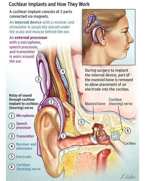 JAMA Network’s Instagram photo: “Cochlear Implant Surgery For many people, the sound after cochlear implantation is not clear right after activation. Hearing with a…” Advanced Bionics Cochlear Implant, Audiology Student, Islam Guide, History Islam, Speech And Hearing, Sound Science, Quran Mp3, Neck Surgery, Science Quotes