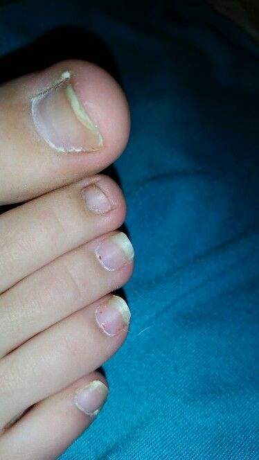 Are you toenails braking off, well no more yucky tonails, are they dirty and ugly? Soak them in BAKING SODA and PROXCIDE for 30 min, for 2 weeks, once you have done that wipe off some of the baking soda and put socks on, and sleep with them on over night, NOTE: make sure your toes are clean, and put as much baking soda and peroxide as needed until it is liquidy and kind of thick, HAVE FUN!!!! FOLLOW ME FOR MORE GREAT STUFF Ugly Toenails, Homemade Foot Soaks, Listerine Foot Soak, Diy Foot Soak, Foot Soak Recipe, Baking Soda Scrub, Baking Soda Face, Baking Soda Bath, Baking Soda Benefits