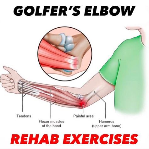 Dr. Tom Walters, DPT, OCS on Instagram: "💥𝐌𝐞𝐝𝐢𝐚𝐥 𝐄𝐩𝐢𝐜𝐨𝐧𝐝𝐲𝐥𝐚𝐥𝐠𝐢𝐚💥 ——— 📚Pain on the inside of the elbow is often thought to be associated with irritation of the tendons of the wrist and finger flexor muscles as they attach on the medial epicondyle at the inside of the elbow. This region of pain is usually diagnosed as medial epicondylalgia or ‘golfer’s elbow’. - 🔎Pain in this region is often associated with activities that require repetitive use of the fingers and wrist or activities that are likely to surpass the strength capacity of these muscles (climbing, gripping, etc). - 🧠Because golfer’s elbow is associated with the tendons attaching at the medial or inside of the elbow, it can really be broadly classified as a tendinopathy. And, like other tendinopathies, it Arm Bones, Ulnar Nerve, Golfers Elbow, Elbow Pain, Trigger Point Therapy, Trigger Points, Sports Health, Upper Arms, Muscles