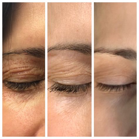 Get Rid of Forehead Wrinkles with Plasma Pen Fibroblasting Brow Wrinkles, Plasma Facial, Fibroblast Plasma, Laser Skin Tightening, Facial Procedure, Plasma Pen, Laser Skin Resurfacing, Botox Cosmetic, Skin Tightening Treatments