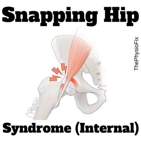 Dr. Stacie | Physical Therapist + Strength Coach on Instagram: "🎁 (INTERNAL) SNAPPING HIP SYNDROME 🎁 📍Snapping Hip Syndrome is a dysfunction where you feel a “snap”, “pop” or “click” when performing various hip movements. There are 2 main types: internal & external. Today we'll be talking about Internal Snapping Hip Syndrome and the main culprit... the iliopsoas tendon. 📍The iliopsoas tendon is made of 2 muscles at the front of the hip: the iliacus & psoas major. What happens is when you mov Snapping Hip Syndrome, Hip Movement, Sore Hips, Sciatica Exercises, Hip Flexor Stretch, Deep Squat, Knee Up, Hip Muscles, Hip Pain