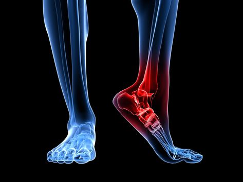 Achilles Tendon, Trigger Point Therapy, Carpal Tunnel, Trigger Points, Foot Health, Foot Pain, Sciatica, Nerve, Body Health