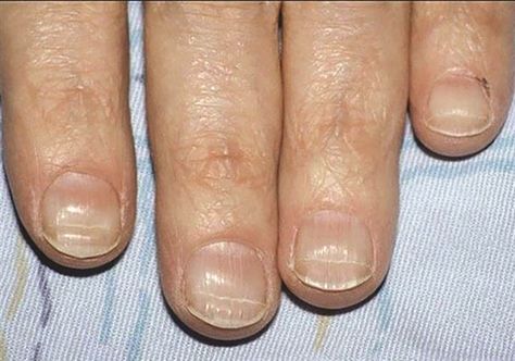 http://www.nailsmag.com/article/116697/something-to-talk-about-beaus-lines Dents In Nails, Horizontal Nail Ridges, Nail Health Signs, Nail Structure, Fingernail Health, Pale Nails, Nail Disorders, Nail Ridges, Nail Signs