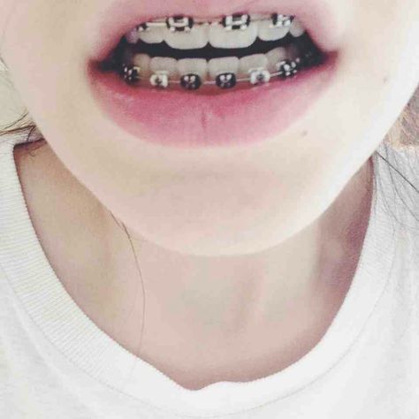 Black and white bands Black Braces, Cute Braces Colors, Getting Braces, Braces Girls, Health Aesthetic, Cute Braces, Brace Face, Braces Colors, Straight Teeth