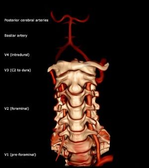 Vertebral Artery Test - Physiopedia Neurosurgery Study, Arteries Anatomy, Forensic Pathology, Thoracic Duct, Subclavian Artery, Subarachnoid Hemorrhage, Occipital Neuralgia, Vertebral Artery, Cervical Vertebrae