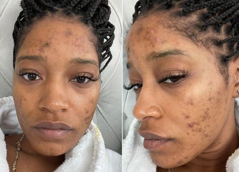 Blind Pimple, Forehead Acne, Pimples Under The Skin, Pimples Overnight, Prevent Pimples, Natural Acne Remedies, How To Get Rid Of Pimples, Acne Causes, Keke Palmer