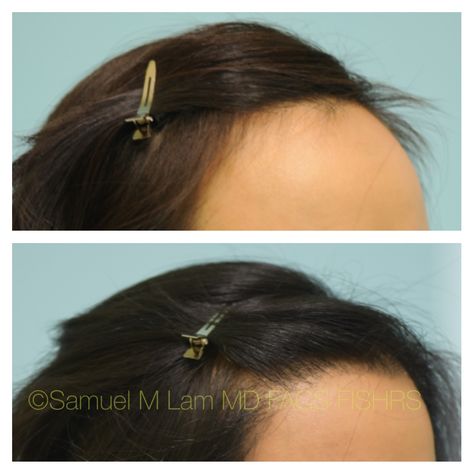 This 33-year-old Asian woman is shown before and 10 months after female hairline lowering for a high hairline via hair transplant. Female Hairline, Hair Transplant Women, Female Hair, Hair Transplant, Womens Hairstyles, Ear Cuff, Hair