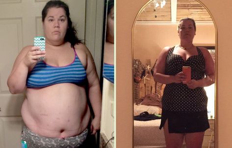 Elizabeth Wolinksy gastric bypass Bypass Surgery Diet, Liver Shrinking Diet, Smaller Stomach, Stomach Pouch, Gastric Bypass Diet, Gastric Bypass Recipes, Bariatric Sleeve, Lap Band, Bariatric Surgeon