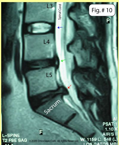 Bulging Disc, Tight Hip Flexors, Hip Flexor Stretch, Psoas Muscle, Spine Health, Sciatic Nerve Pain, Sciatic Nerve, Joints Pain Relief, Back Pain Exercises