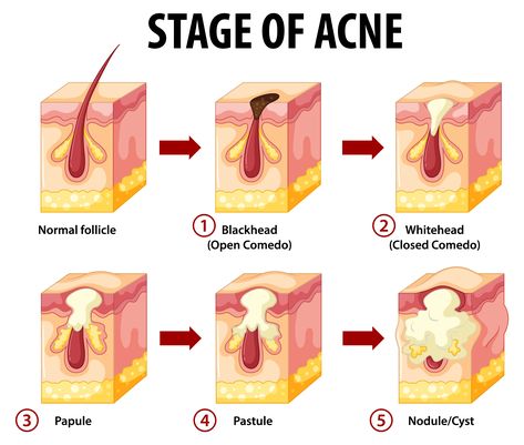 Everyone familiar with the problem of scalp acne, pimples, and sores knows firsthand how unpleasant and annoying the condition is. When you get acne on your scalp, you can’t fend off that horrible itching, which makes you nervous and irritated all the time. All your thoughts are about the pimples on the scalp that are … Pimples On Scalp, Painful Pimple, Scalp Acne, Back Acne Remedies, Blind Pimple, Pimples Under The Skin, How To Get Rid Of Pimples, Acne Causes, Hormonal Acne