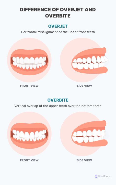 Overjet Overbite, Overbite Braces, Overbite Correction, Fix Overbite, Braces Transformation, Dental Facts, Healthy Bites, Just A Reminder, Morning Yoga