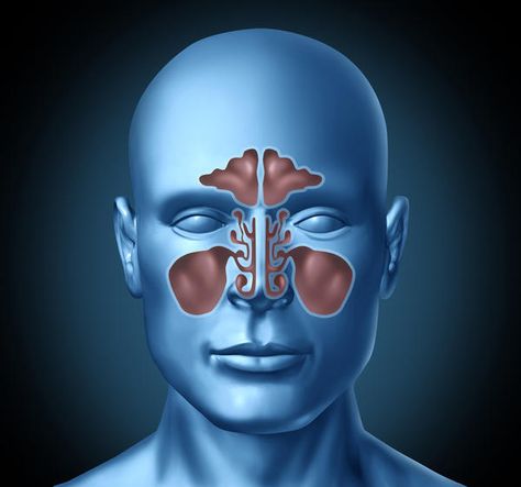 sinusitis and viral meningitis Home Remedies For Sinus, Relieve Sinus Pressure, Sinus Congestion Relief, Sinus Cavities, Sinus Infection Remedies, Remedies For Tooth Ache, Sinus Pain, Mold Exposure, Sinus Problems