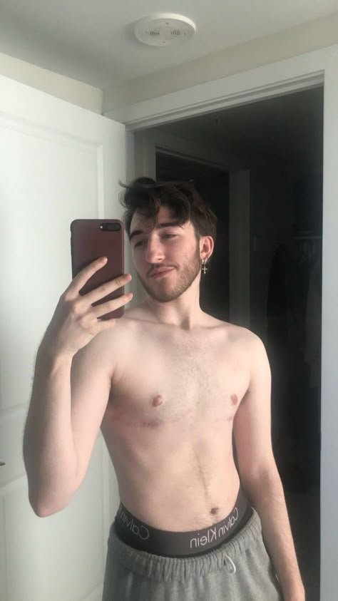 Surgery update almost 1 year (10 months) post op Dr Ramineni : ftm Post Op Top Surgery, Too Surgery Ftm, Trans Guy Top Surgery, Miles Mckenna Top Surgery, Trans Ftm Top Surgery, Trans Surgery Ftm, Phalloplasty Ftm Results, Top Surgery Scars Aesthetic, Bottom Surgery Ftm