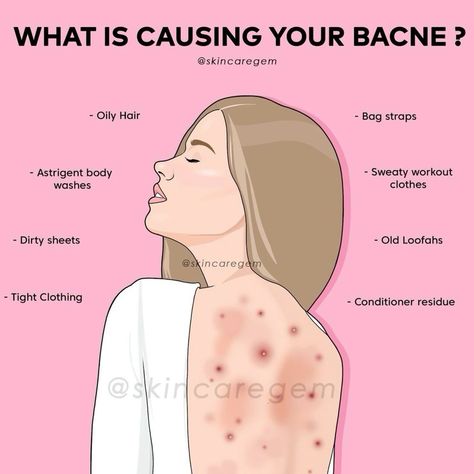 Acne Tips, Girly Tips, Back Acne, Skin Advice, Glow Ups, Clear Healthy Skin, Basic Skin Care, Good Skin Tips, Body Acne