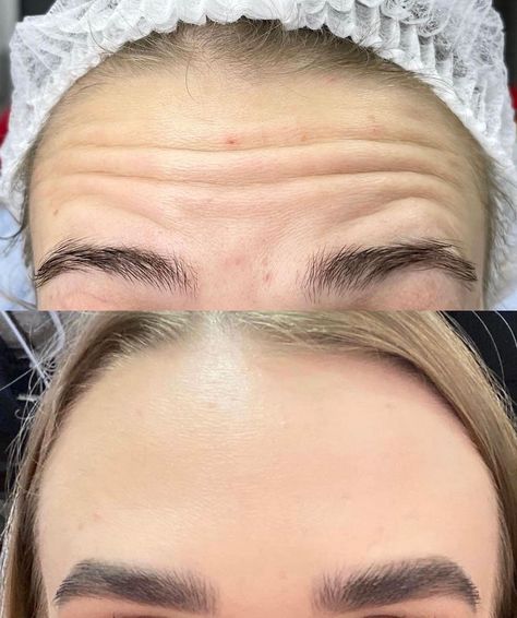 Botox For Wrinkles, Botox Day, Botox Frown Lines Before After, Botox Inspiration, Botox Aesthetic, Botox Instagram, Botox Astetic, Botox Locations On Face, Botox Facial