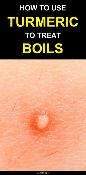 Natural Remedies For Boils, Boil Remedies, How To Treat Boils, Get Rid Of Boils, Home Remedy For Boils, Tea Remedies, Unhealthy Diet, Hair Follicles, Bacterial Infection