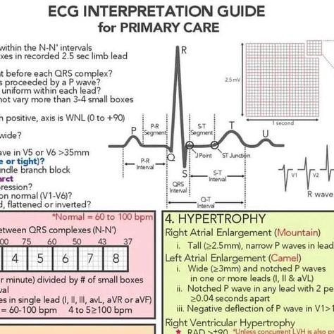 HouseOfMedicalKNLWandSkills on Instagram: "#heart #cardiology EKG Made Easy !💪💪💪 Follow us on IG: http://www.instagram.com/houseofmedicalknlwandskills Follow us on Twitter: http://www.twitter.com/HouseofmedicalK" Ekg Interpretation Made Easy Cheat Sheets, Ekg Interpretation Made Easy, Ekg Interpretation, Ecg Interpretation, P Wave, Instagram Heart, Nurse Rock, Med Surg, Physician Assistant