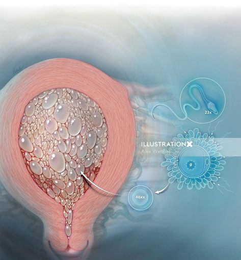 Artistic interpretation of complete molar pregnancy. Overlay showing fertilization of egg containing no nuclear material resulting in trophoblastic proliferation (cytotrophoblast and syncytiotrophoblast) Mole Meaning, Fertilization Process, Molar Pregnancy, Face Pores, Pregnancy Art, Ginger Smoothie, Dream Symbols, Dream Meanings, Dream Interpretation