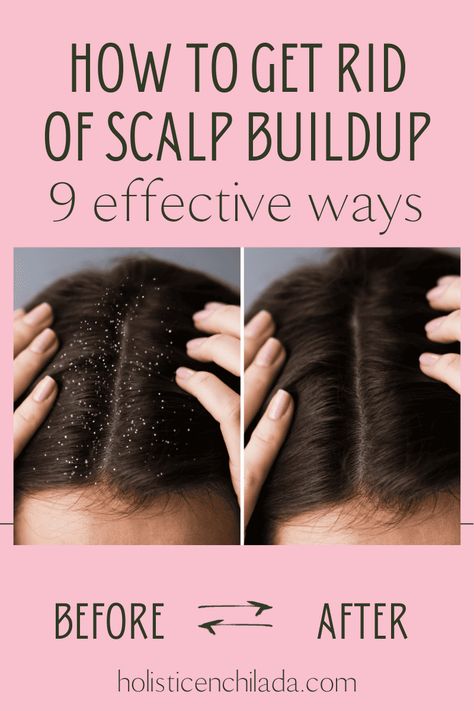 Wondering how to get rid of scalp buildup? Explore these 9 highly effective ways to achieve a cleaner, flake-free scalp with these expert-recommended strategies. How To Get Rid Of Flakes In Hair, Remove Buildup From Scalp, Diy Hair Mask For Dry Flaky Scalp, How To Get Rid Of Product Build Up, What Helps With Dry Scalp, Remove Scalp Buildup Diy, Flakey Scalp How To Get Rid Of, Dry Itchy Flaky Scalp Remedy, Sebum Buildup On Scalp