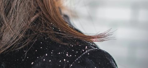 No one likes a flake, especially the ones that fall from your scalp. Here are the best natural remedies for dandruff for major scalp relief. How To Remove Dandruff, Severe Dandruff, Natural Dandruff Remedy, Dandruff Causes, Home Remedies For Dandruff, Dandruff Remedy, Getting Rid Of Dandruff, Flaky Scalp, Anti Dandruff Shampoo