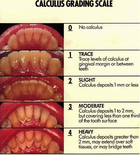 denta calculus grading scale Dental Hygienist School, Dental Assistant Study, Registered Dental Hygienist, Dental Hygiene Student, Dental World, Grading Scale, Dental Hygiene School, Dental Anatomy, Dental Fun