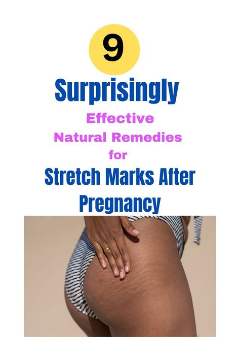 Learn simple strategies and natural solutions for reducing & removing stretch marks after pregnancy. Find out how to prevent and reduce the appearance of stretch marks during and after pregnancy. Unlock Stretch Mark Skincare Secrets! 😘 stretch mark on neck, stretch mark on knee, stretch mark on hips #stretchmarks #selfcare #healthyskin Stretch Mark Removal Cream, Stretch Mark Remedies, Postpartum Essentials, Marks Cream, Best Lotion, Stretch Mark Removal, Stretch Mark Cream, Stretch Mark, Skin Secrets