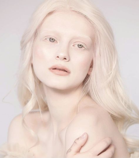 #albinogirl #albino #albinism #whitehair #white Albino Girl, Long White Hair, Angels Beauty, Arte Peculiar, Targaryen Aesthetic, Favorite Hairstyles, Skin Conditions, Drawing People, Beautiful Eyes