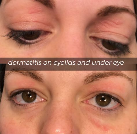 dermatitis on eyelids and under eye Dry Skin Around Eyes Remedies, Eyelid Irritation Remedies, Eyelid Excema, Contact Dermitis Face, Dry Eyelids Remedy, Swollen Eyelids Remedy, Itchy Eyes Remedy, Dry Skin Around Eyes, Itchy Eyelids