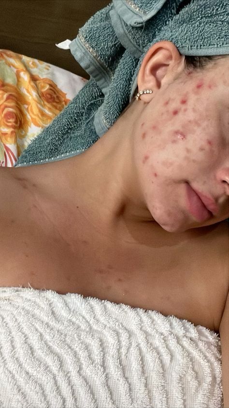 Acne Face Aesthetic, Bad Skin Pictures, Body Acne Positivity, Acne Aesthetic Girl, Bad Acne Pictures, Acne Skin Aesthetic, Pimples Aesthetic, Breakouts On Face, Girls With Acne