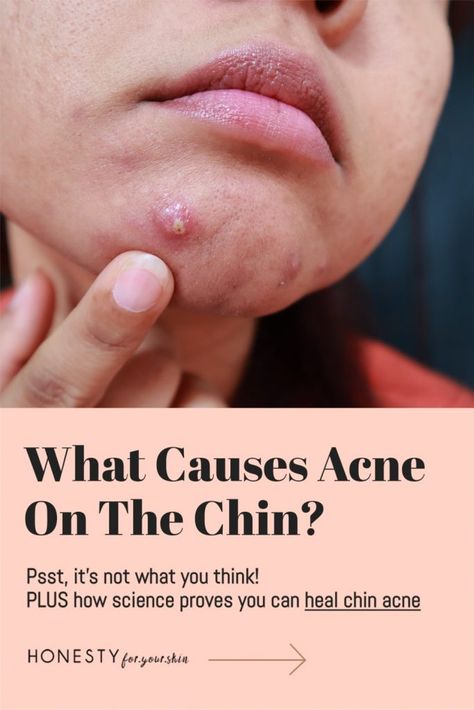 Spots On Face Meaning, Get Rid Of Chin Acne, Pimples On Face Meaning, Chin Acne Causes, Blemishes On Face, Cystic Acne On Chin, Nails Remedies, What Causes Acne, Inflamed Pimple