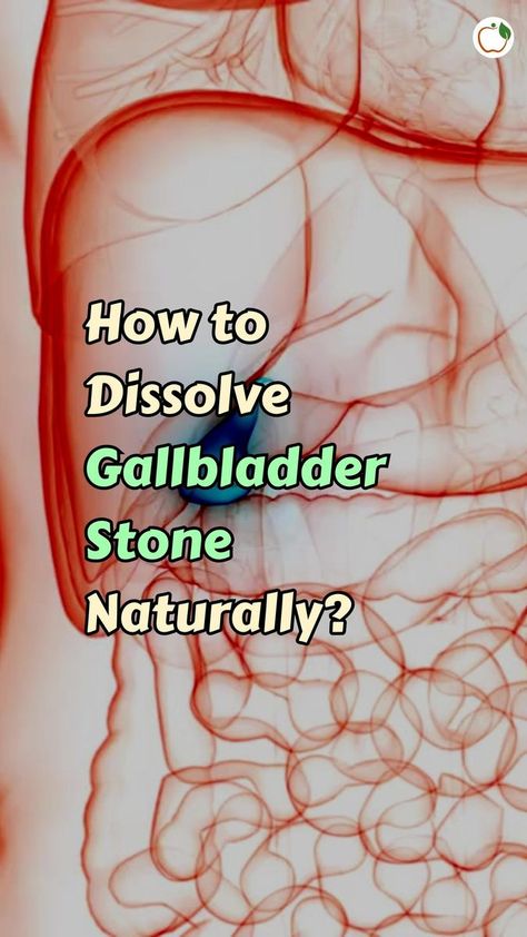 How To Dissolve Gallbladder Stones, Diet For Gallbladder Stones, Gallstone Diet Meals, Gallbladder Stones Diet, Gallstone Diet, High Cholesterol Symptoms, Gallbladder Stones, Herbal Vitamins, Makeup Removal Tips