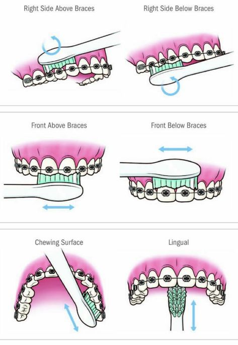 Dental Braces Colors, Braces Food, Braces Ideas, Cute Braces Colors, Braces Tips, Getting Braces, Cute Braces, Kedokteran Gigi, Brace Face