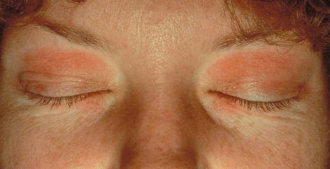 Eyelid Dermatitis (xeroderma of the eyelids, eczema of the eyelids, atopic dermatitis, allergic contact dermatitis, irritant contact dermatitis, seborrheic dermatitis of the eyelids) - Dermatology Advisor Skin Disorders, Itchy Skin, Dermatology, For Men, Skin, Health