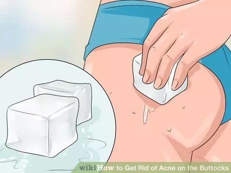 Image titled Get Rid of Acne on the Buttocks Step 9 Boils On Buttocks, How To Stop Pimples, Buttocks Acne, How To Treat Pimples, Get Rid Of Spots, Pimples On Buttocks, Painful Pimple, Pregnancy Acne, Pimples On Forehead