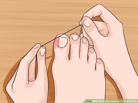 5 Ways to Relieve Ingrown Toe Nail Pain - wikiHow Toenail Pain, Physical Therapy Exercises, Ingrown Nail, Ingrown Toe Nail, Dental Floss, Homemade Remedies, Health Info, Health And Beauty Tips, Body Health