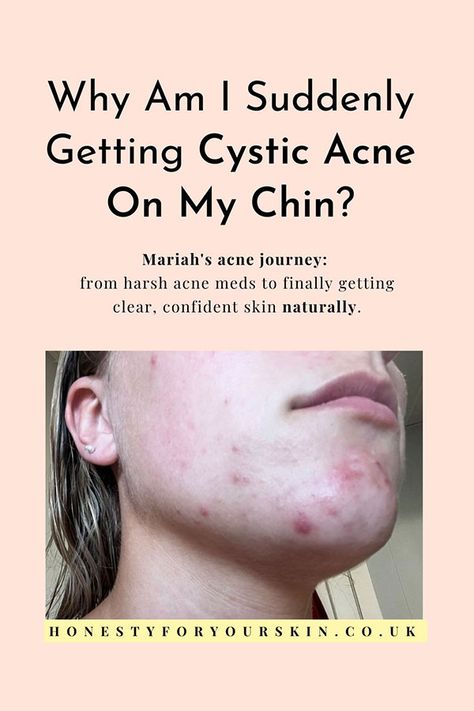 Why am I suddenly getting cystic acne on my chin? What hormone causes hormonal spots on chin? What if my hormones are normal? What Causes Cystic Acne, Chin Acne Causes, Blemishes On Face, Cystic Acne On Chin, Jawline Acne, Painful Pimple, Acne Positivity, Clear Skin Remedies, Get Rid Of Spots