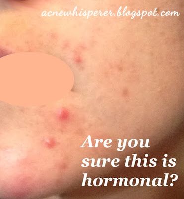 Adult Acne Tip : What you think is a stubborn hormonal breakout might not be!  Find out more on the Acne Whisperer Blog. Chin Acne, Cystic Acne Remedies, Stubborn Acne, Hormonal Breakouts, Natural Acne Remedies, Home Remedies For Acne, How To Get Rid Of Pimples, Acne Problem, Acne Scar Removal