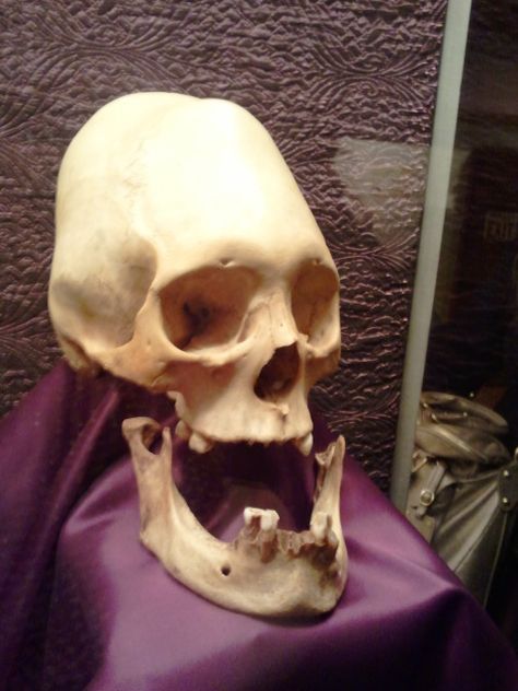 Skull with dislocated jaw Dislocated Jaw, Art