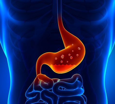 Stomach acid is a necessary and vital part of digestion. Yet, stomach acid has become enemy number one in the United States. Fast Tract Diet, Ibs Diet Plan, Ibs Diet, Stop Acid Reflux, Low Stomach Acid, Reflux Disease, Stomach Ulcers, Irritable Bowel, Alkaline Foods