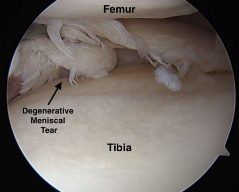 Meniscus surgery for complex degenerative tears can be avoided – Howard J. Luks, MD Knee Replacement Surgery, Meniscus Surgery, After Care, Meniscal Tear, Knee Replacement, Primary Care Doctor, Resistance Workout, After Surgery, Hang On