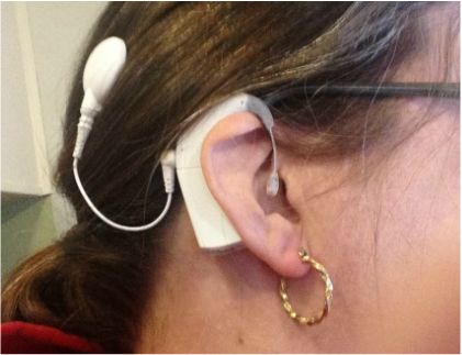 Picture of a side view of a white cochlear implant on my head Cochlear Implant Accessories, Cochlear Implants, Cochlear Implant, Side View, Ear Cuff, The Internet, Hoop Earrings, Internet, White