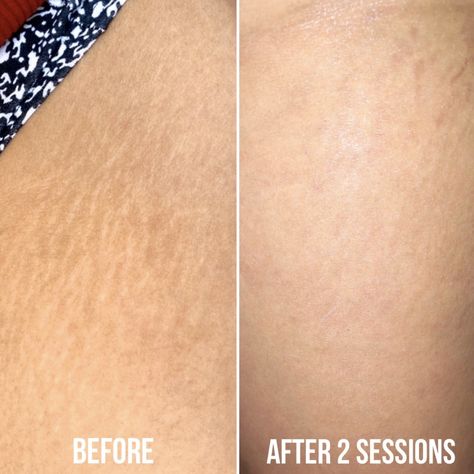 Cover Up Tattoos Before And After, Will Tattoo, Tattoo Concealer, Strech Marks, Stretch Mark Remedies, Marks Cream, Tattoo Makeup, Stretch Mark Removal, Stretch Mark Cream