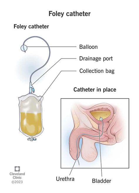 What Is a Foley Catheter? Foley Catheter Nursing, Catheter Insertion, Er Tech, Foley Catheter, Medical School Essentials, Cleveland Clinic, Future Nurse, Elderly Care, Medical Device