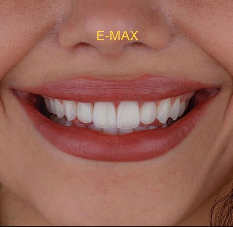 Sharp Canines, Perfect Smile Teeth, Smile Tips, Teeth Aesthetic, Pretty Teeth, Veneers Teeth, Dental Fillings, Aesthetic Dentistry, Beautiful Teeth