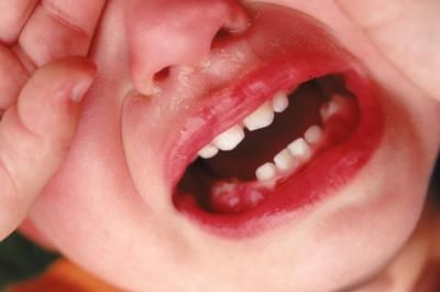 Problems from loosing Baby Teeth Swollen Gum, Loose Tooth, Baby Gums, Fever Reducer, White Patches, Family Health, Baby Teeth, Tooth Decay, Homeopathy