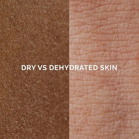 Do you have dry or dehydrated skin? Comment below 👇🏼 #dryvsdehydrated #marycohr #dryskin #dehydratedskin Skin Care For Dehydrated Skin, Dehydrated Face Skin Tips, Oily And Dehydrated Skin, Dry Vs Dehydrated Skin, Skincare For Dehydrated Skin, Dehydration, Dehydrated Skin, Dry Skin, Skin