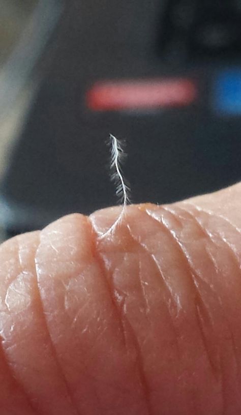 Nanotechnology, Part 1. Morgellons Disease – Time for Truth Dog Whiskers, Diseases Pictures, Health Images, Rare Disease, Wound Care, Mental Disorders, Skin Diseases, Nanotechnology, Medical Conditions